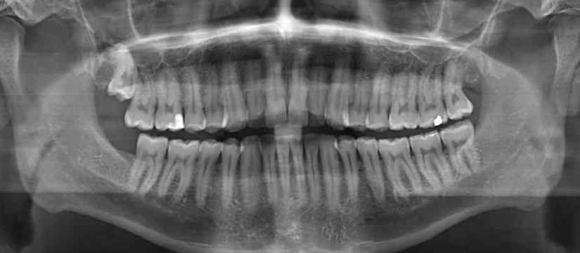periodieke-tandarts-controle-rontgenfoto